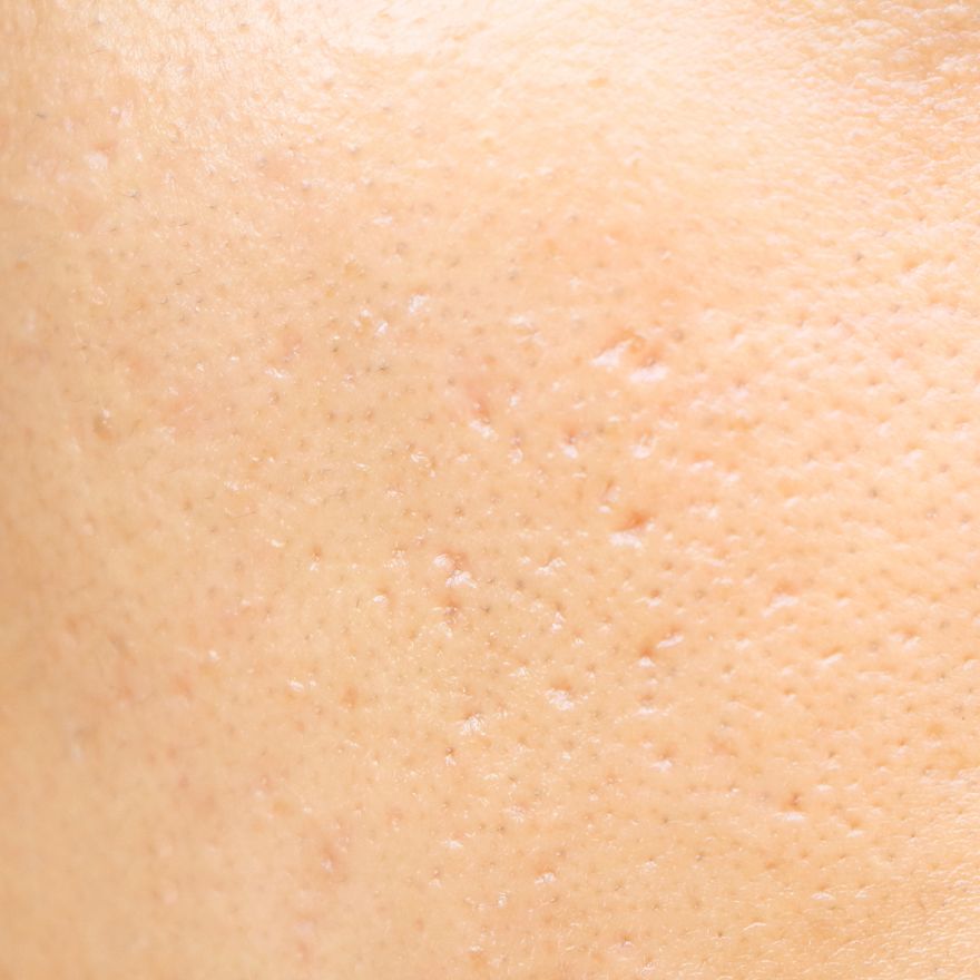 Pores dilatés quelles solutions pour les resserrer ? Dr Pierre Ricaud